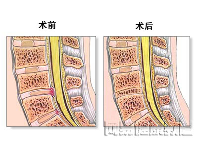 椎间盘突出骨移植修补术图片