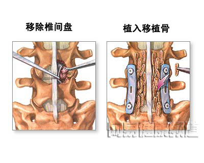 椎间盘突出骨移植修补术图片