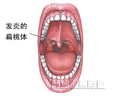 扁桃体切除术图片