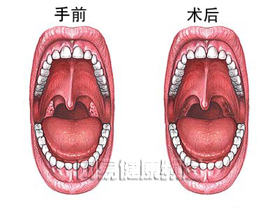 扁桃体切除术图片