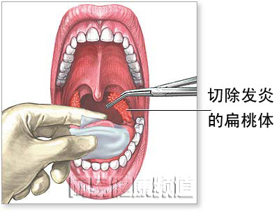 扁桃体切除术图片