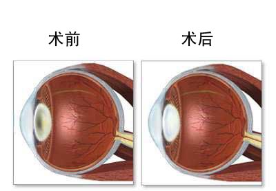 白内障手术图片