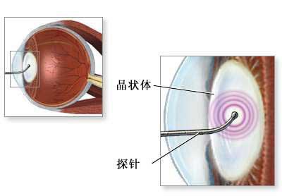 白内障手术图片