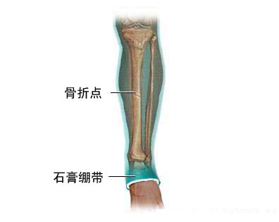 骨折修复术图片