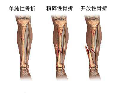 骨折修复术图片