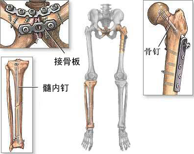 骨折修复术图片