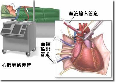 心脏移植术图片