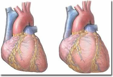 心脏移植术图片