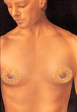 男性乳腺去除术图片